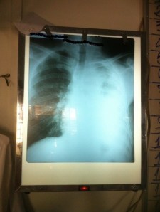 Chest x-ray 001
