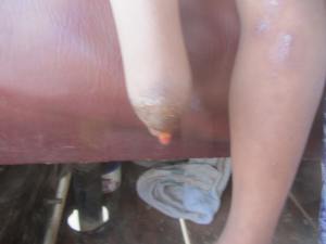 Bone growing through the below-knee amputation of a 6yo.